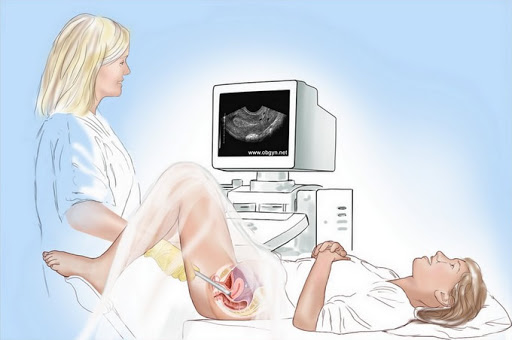Ecografia transvaginala – prima investigatie importanta in sarcina